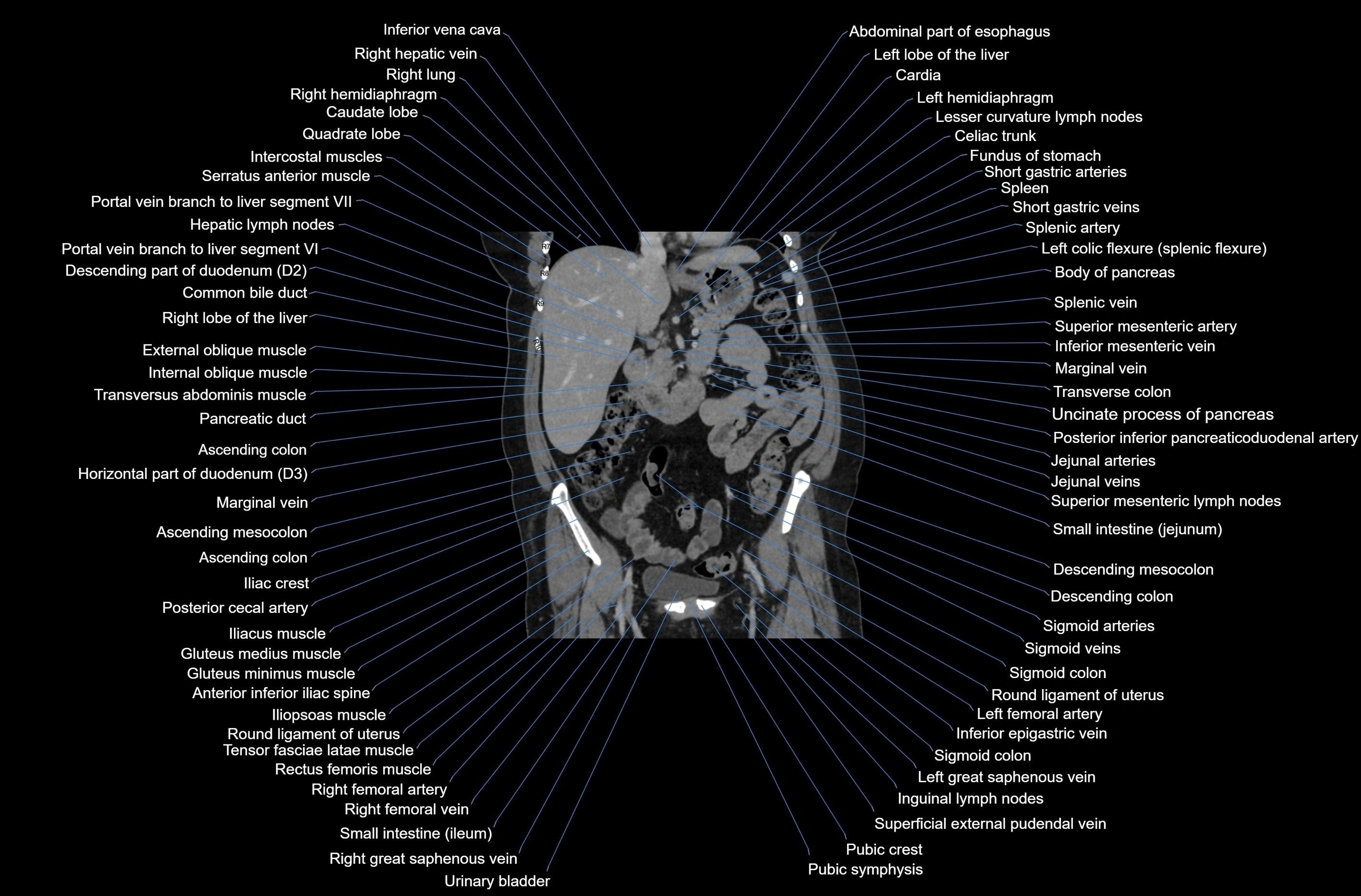 CT abdomen coronal cross sectional anatomy labelled radiology image-00040.webp